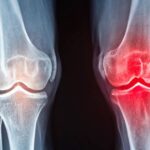 Cartilage in Your Knee